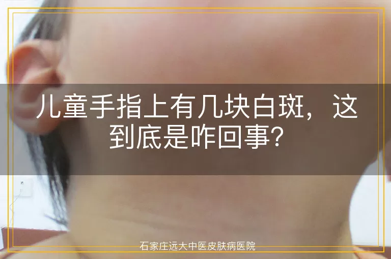 儿童手指上有几块白斑,这到底是咋回事?