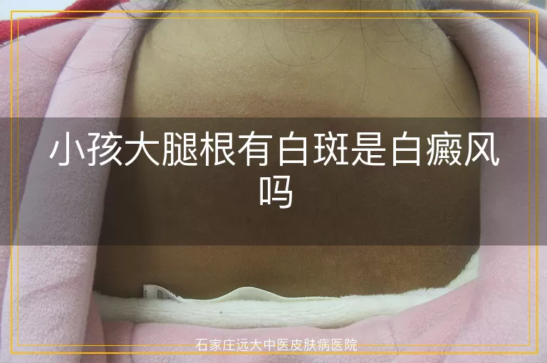 小孩大腿根有白斑是白癜风吗