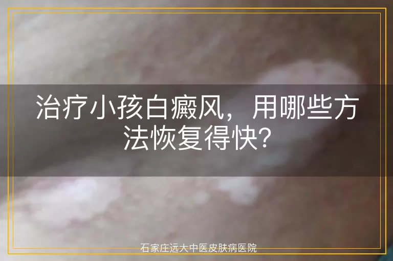 治疗小孩白癜风，用哪些方法恢复得快？