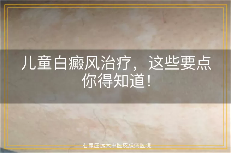 儿童白癜风治疗，这些要点你得知道！
