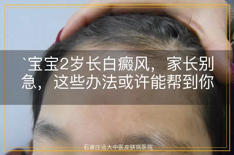 宝宝2岁长白癜风，家长别急，这些办法或许能帮到你
