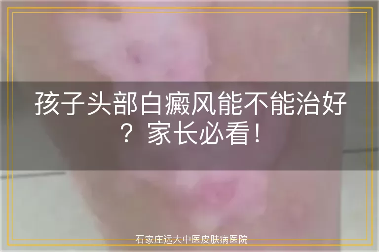 孩子头部白癜风能不能治好？家长必看！