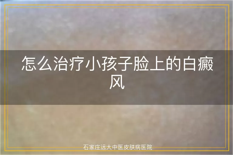 怎么治疗小孩子脸上的白癜风