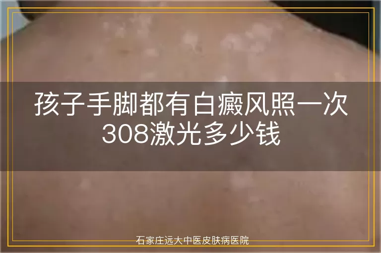 孩子手脚都有白癜风照一次308激光多少钱