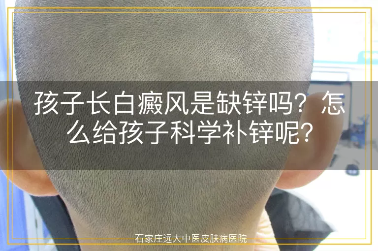 孩子长白癜风是缺锌吗？怎么给孩子科学补锌呢？