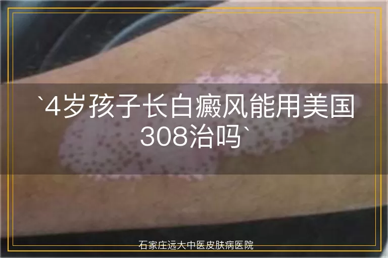 4岁孩子长白癜风能用美国308治吗