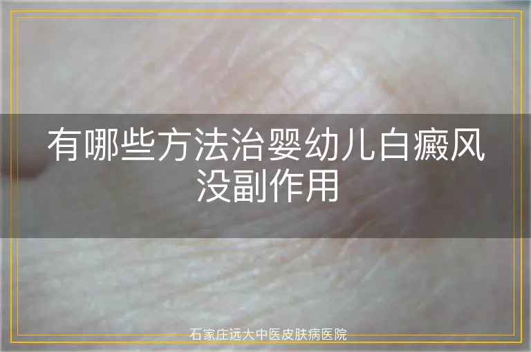 有哪些方法治婴幼儿白癜风没副作用