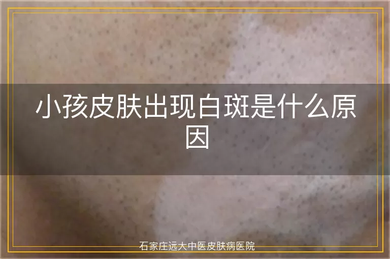 小孩皮肤出现白斑是什么原因