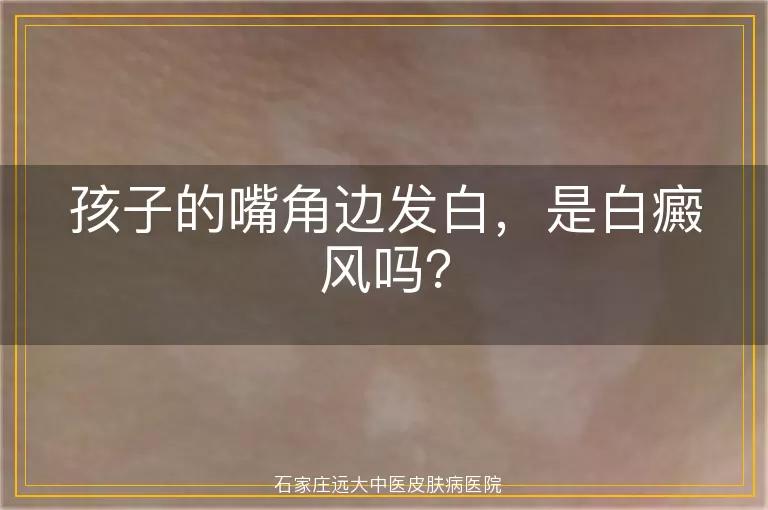 孩子的嘴角边发白，是白癜风吗？