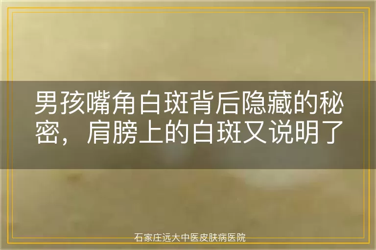 男孩嘴角白斑背后隐藏的秘密，肩膀上的白斑又说明了什么？