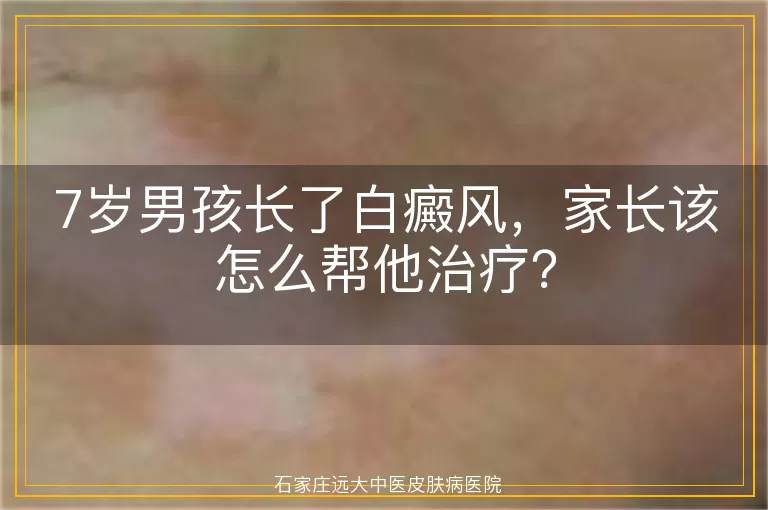 7岁男孩长了白癜风，家长该怎么帮他治疗？