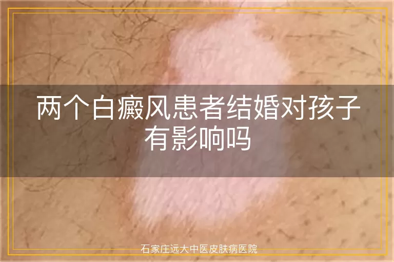 两个白癜风患者结婚对孩子有影响吗