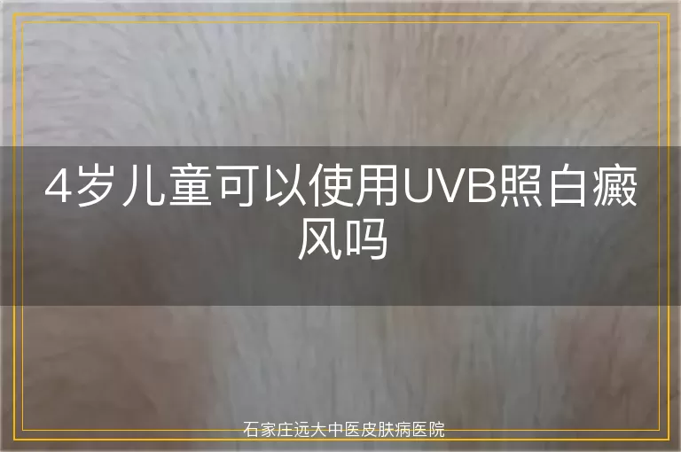 4岁儿童可以使用UVB照白癜风吗