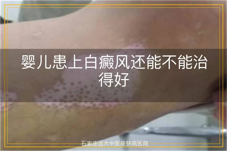 婴儿患上白癜风还能不能治得好
