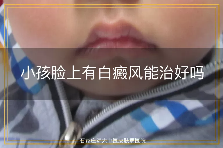 小孩脸上有白癜风能治好吗