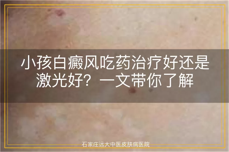 小孩白癜风吃药治疗好还是激光好？一文带你了解