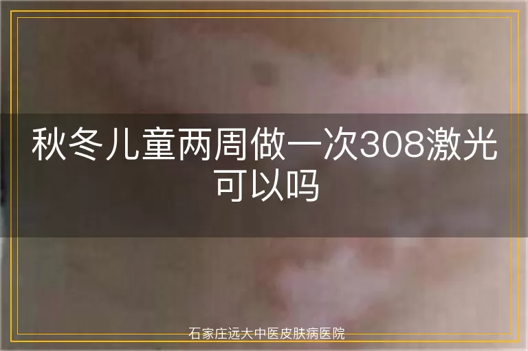秋冬儿童两周做一次308激光可以吗