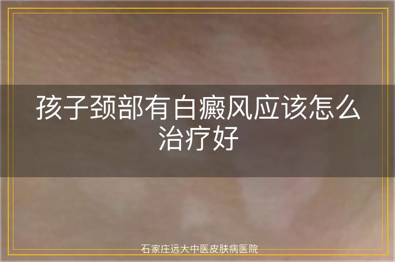 孩子颈部有白癜风应该怎么治疗好