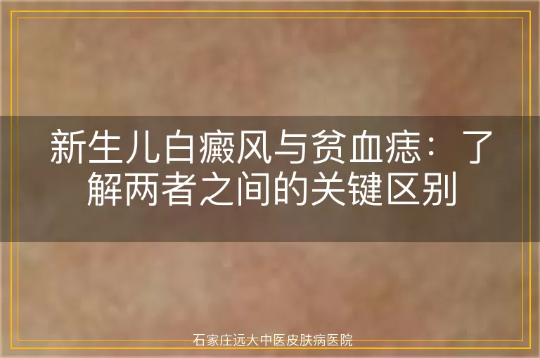 新生儿白癜风与贫血痣：了解两者之间的关键区别