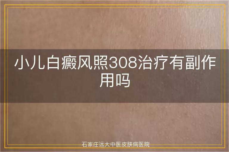 小儿白癜风照308治疗有副作用吗