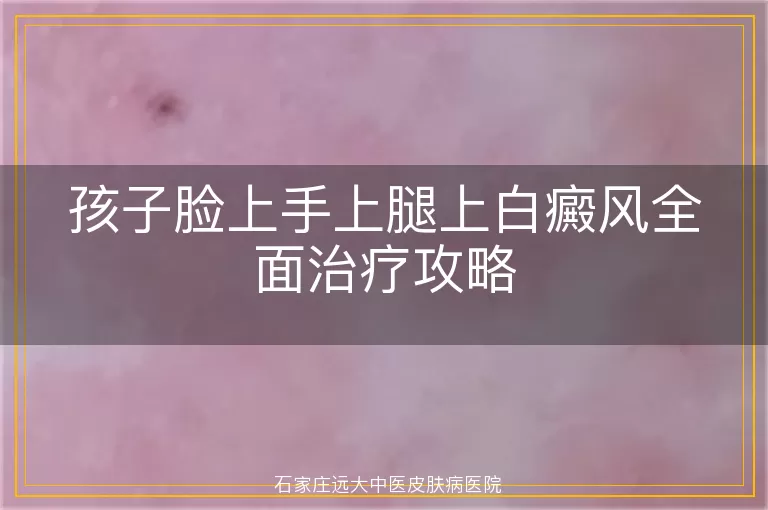 孩子脸上手上腿上白癜风全面治疗攻略