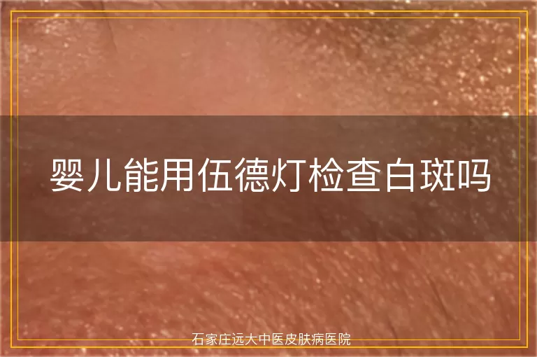 婴儿能用伍德灯检查白斑吗