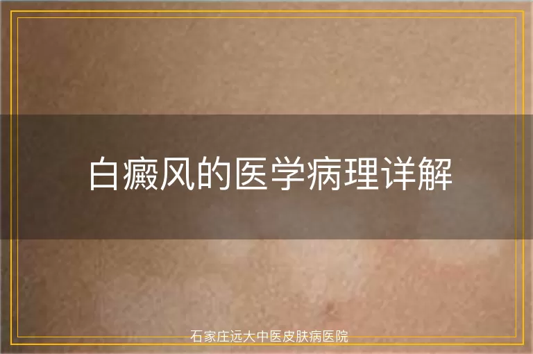 白癜风的医学病理详解