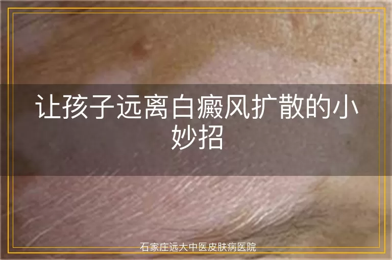 让孩子远离白癜风扩散的小妙招