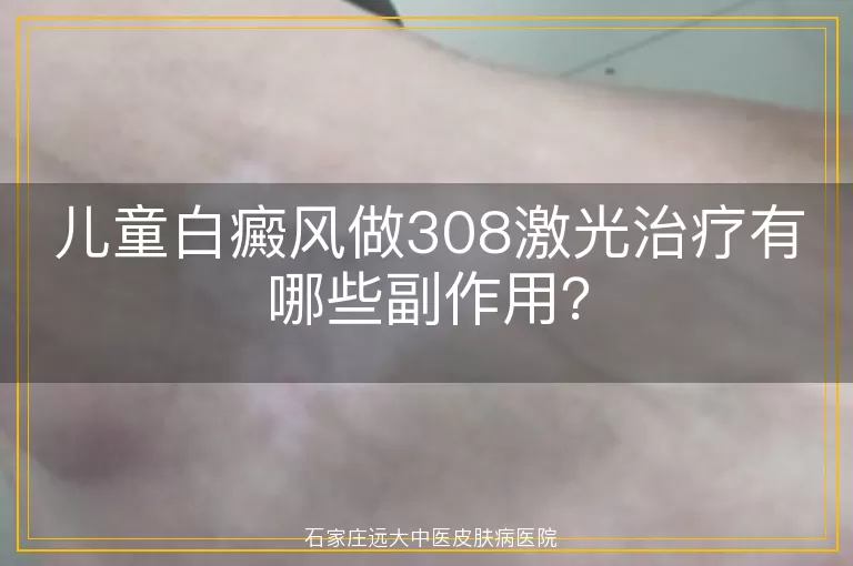儿童白癜风做308激光治疗有哪些副作用?