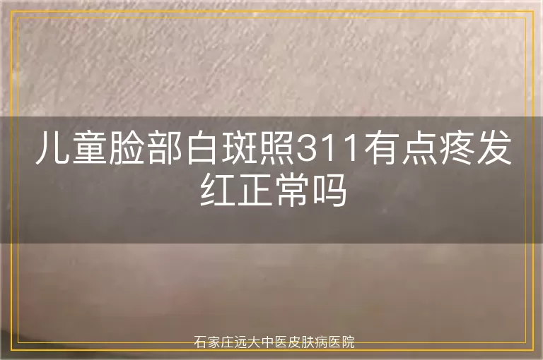 儿童脸部白斑照311有点疼发红正常吗