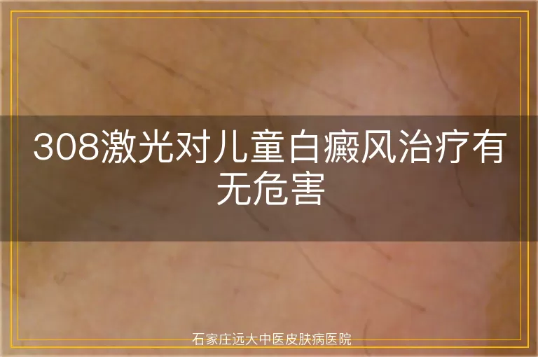 308激光对儿童白癜风治疗有无危害