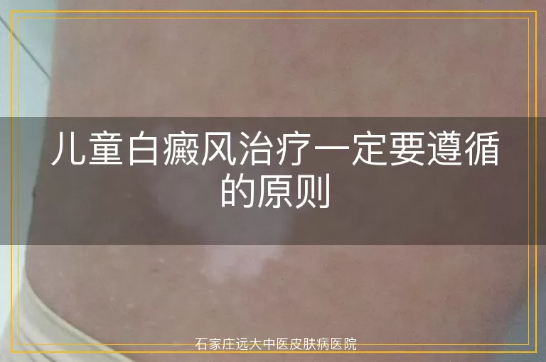 儿童白癜风治疗一定要遵循的原则