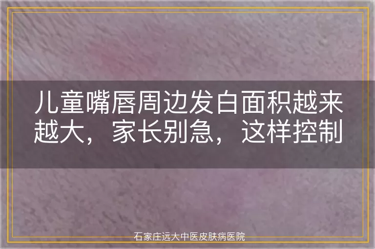 儿童嘴唇周边发白面积越来越大，家长别急，这样控制！