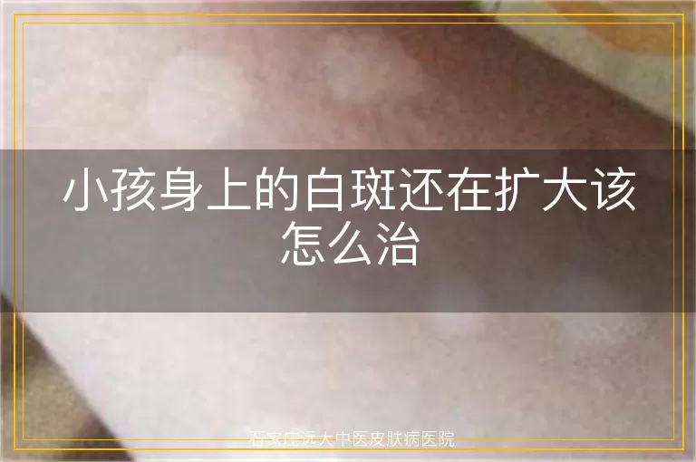 小孩身上的白斑还在扩大该怎么治