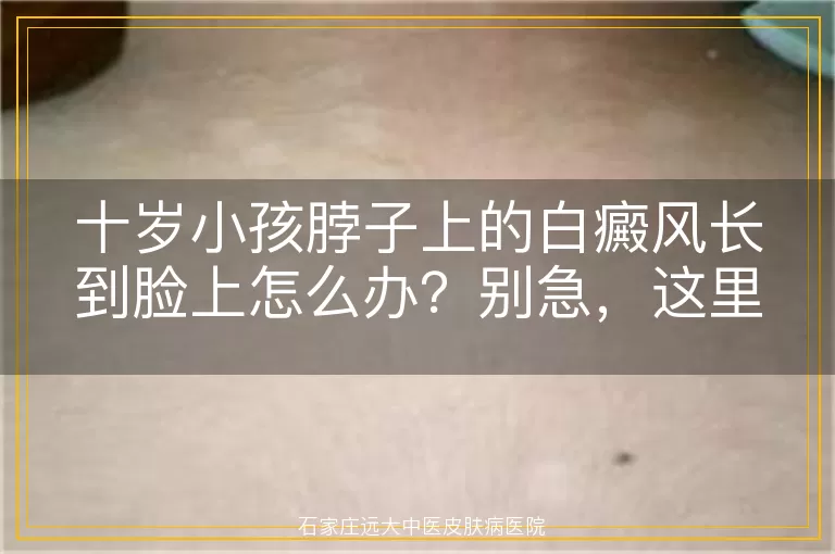 十岁小孩脖子上的白癜风长到脸上怎么办？别急，这里有办法！
