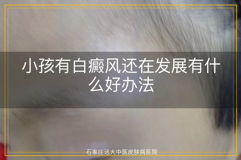 小孩有白癜风还在发展有什么好办法