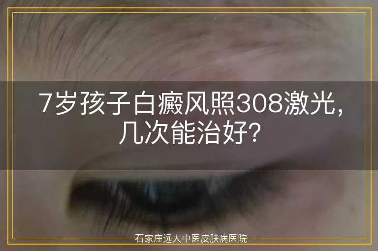 7岁孩子白癜风照308激光，几次能治好？