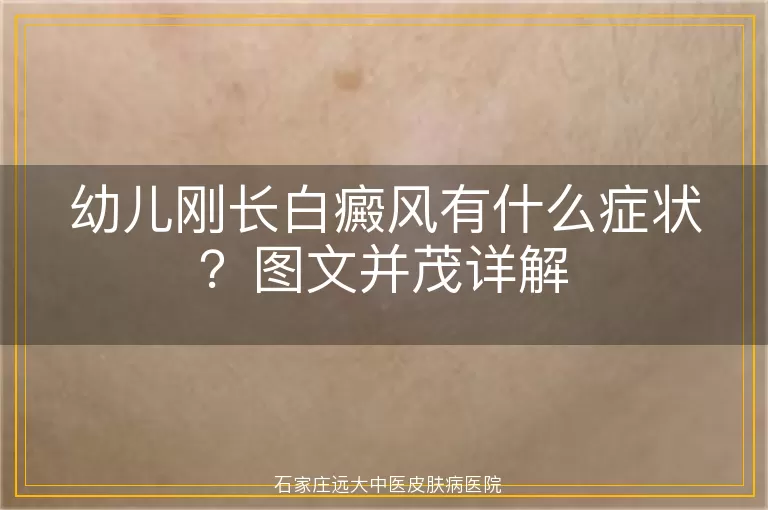 幼儿刚长白癜风有什么症状？图文并茂详解