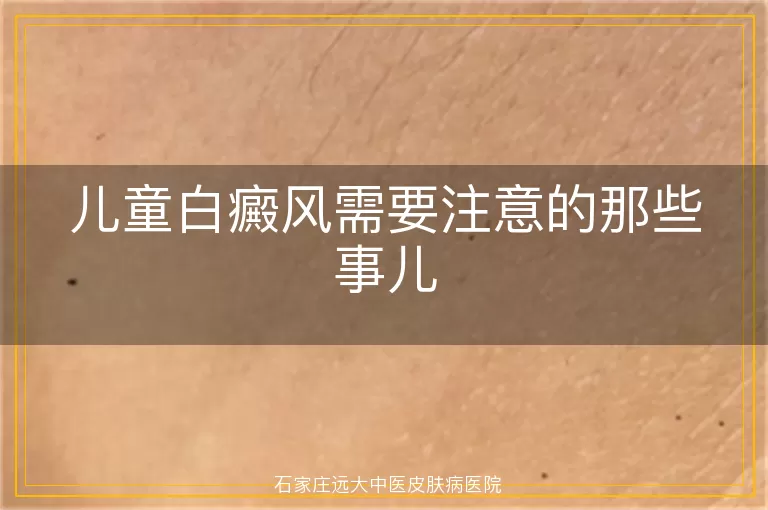 儿童白癜风需要注意的那些事儿