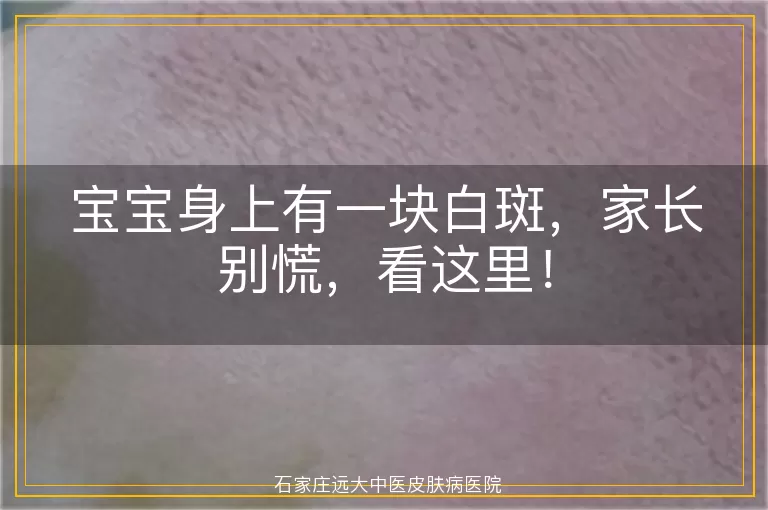 宝宝身上有一块白斑，家长别慌，看这里！