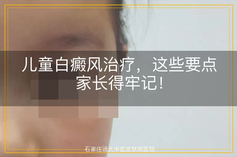 儿童白癜风治疗，这些要点家长得牢记！