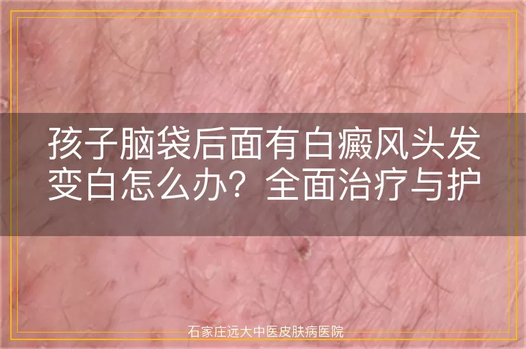 孩子脑袋后面有白癜风头发变白怎么办？全面治疗与护理指南