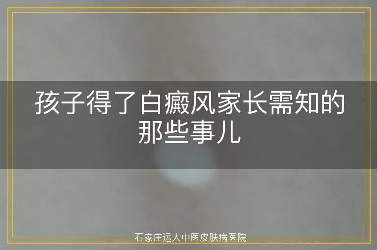 孩子得了白癜风家长需知的那些事儿