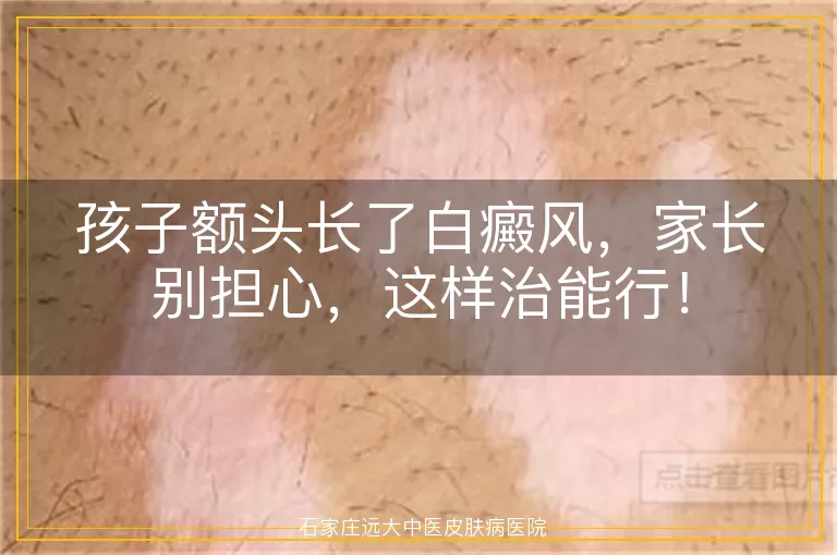 孩子额头长了白癜风，家长别担心，这样治能行！