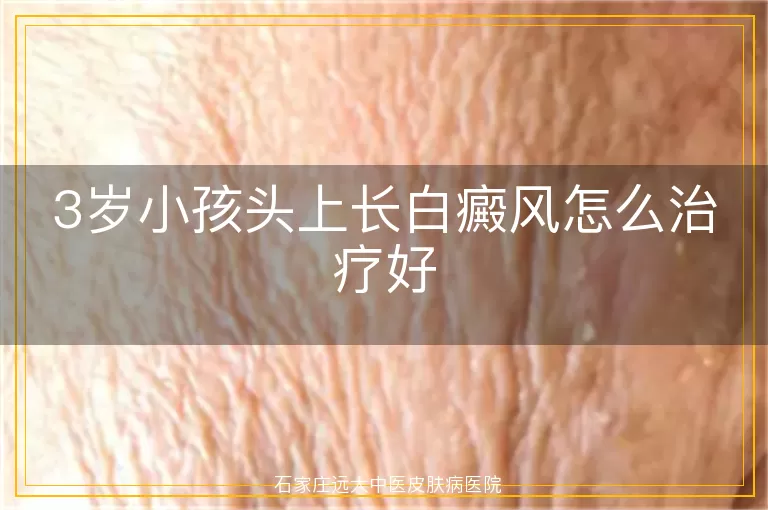 3岁小孩头上长白癜风怎么治疗好