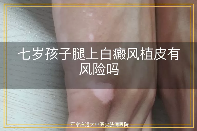 七岁孩子腿上白癜风植皮有风险吗