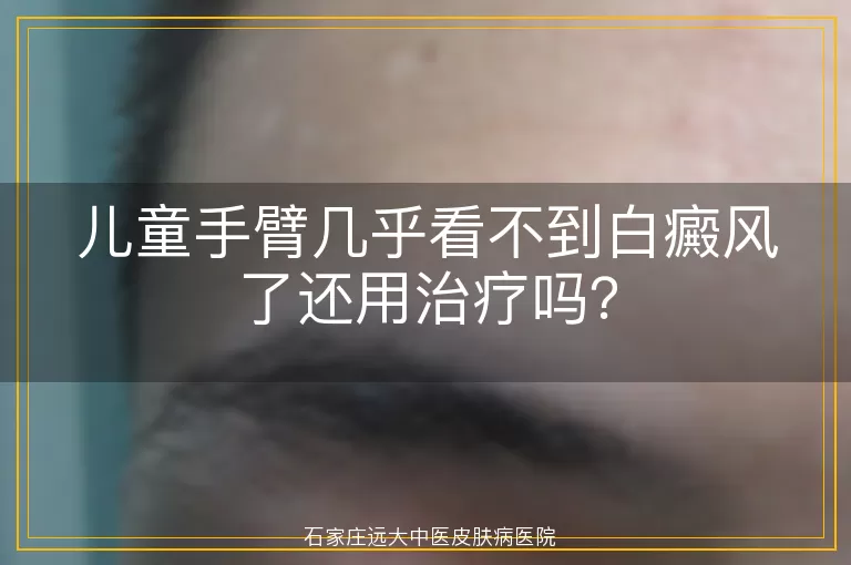 儿童手臂几乎看不到白癜风了还用治疗吗？