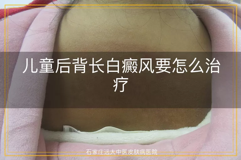 儿童后背长白癜风要怎么治疗
