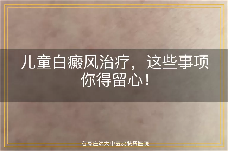 儿童白癜风治疗，这些事项你得留心！
