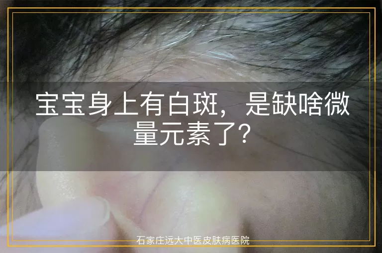 宝宝身上有白斑，是缺啥微量元素了？